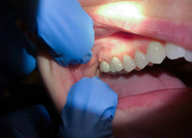 Best Dental Abscess Treatment in Lavalette, WV
